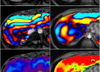 imagen de grados de la fibrosis en el hígado
