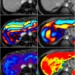 imagen de grados de la fibrosis en el hígado