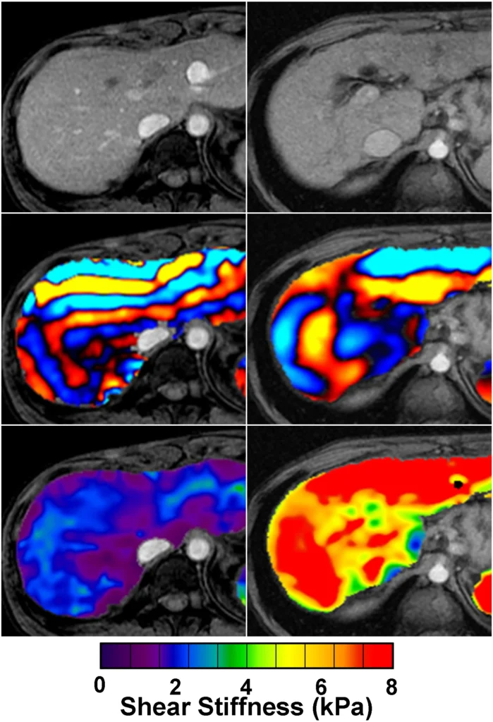 imagen de grados de la fibrosis en el hígado