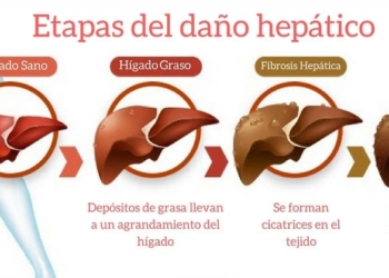 etapas del hígado graso