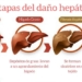 etapas del hígado graso
