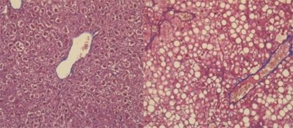 Células hepáticas bajo microscopía. En la parte superior, en un hígado sano, las células hepáticas se organizan normalmente. En la parte inferior, se ve una acumulación de grasa (círculos blancos). © UNIGE