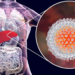 Hepatitis Virales